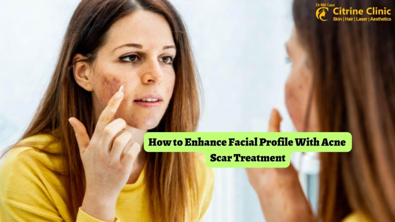 How to Enhance Facial Profile With Acne Scar Treatment