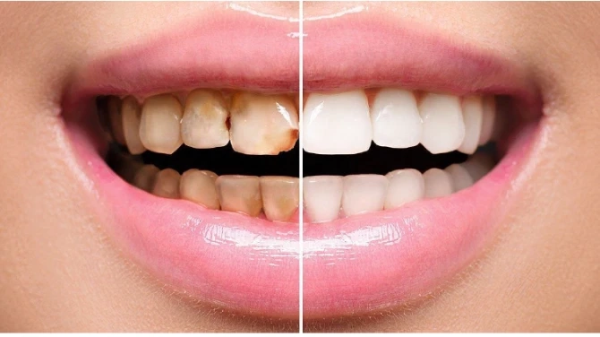 Wish To Change Your Smile From Dull To Dazzling?