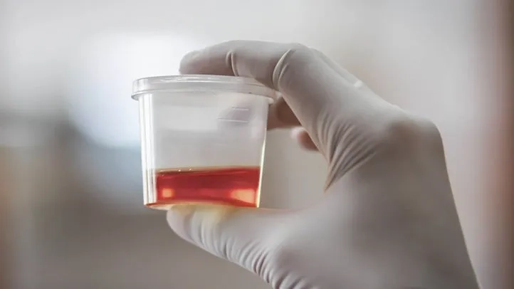 Why Women Experience Blood in Urine: Key Causes Explained