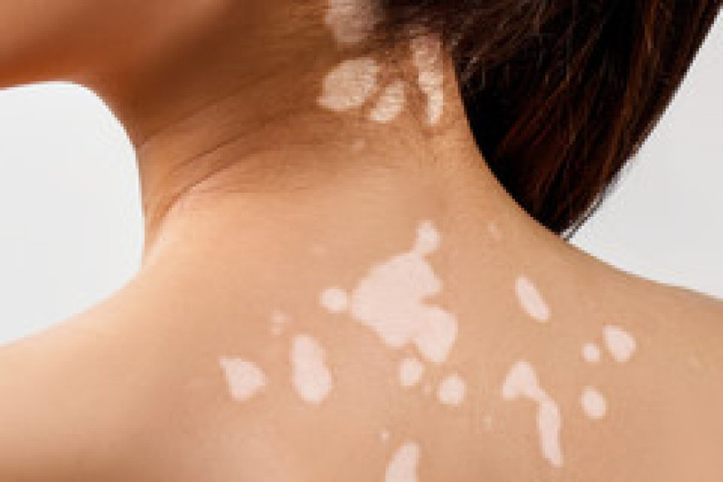 Micropigmentation for Vitiligo Near Me: An Innovative Solution for Skin Pigmentation