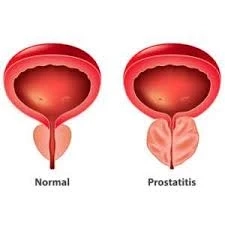 Akut prostatit