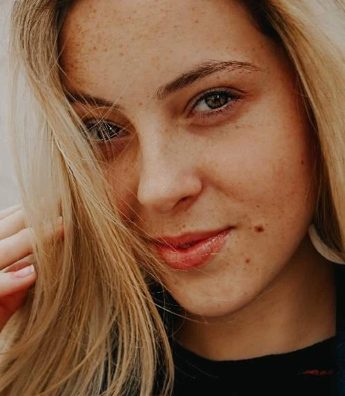 Best Techniques for Pigmentation Treatment in Hyderabad