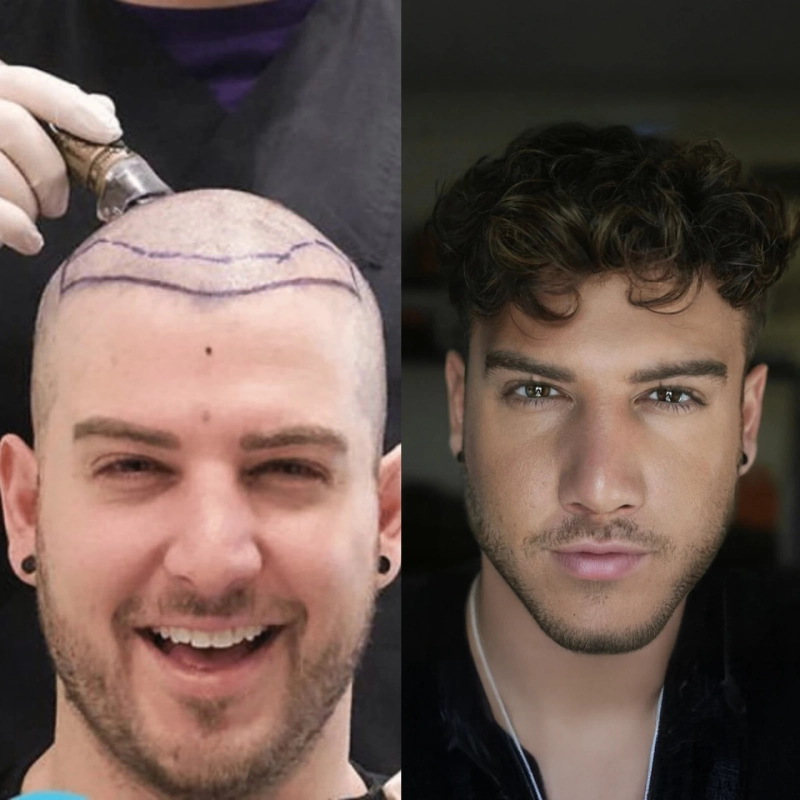 What to Expect from a Hair Transplant Clinic in Istanbul