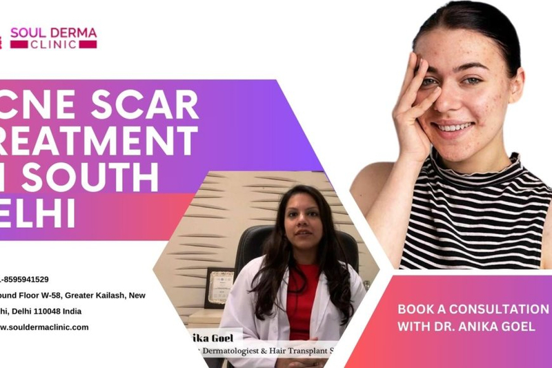 The Ultimate Guide to Effective Acne Scar Treatment: Say Goodbye to Stubborn Scars