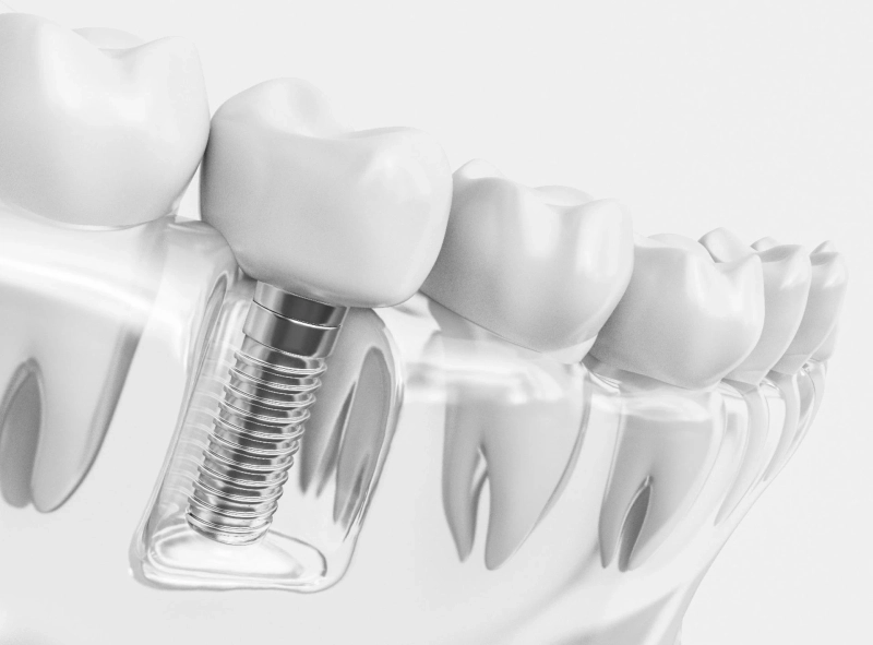The Role of an Implant Dentist in Fairhope, AL: Why You Should Consider Dental Implants