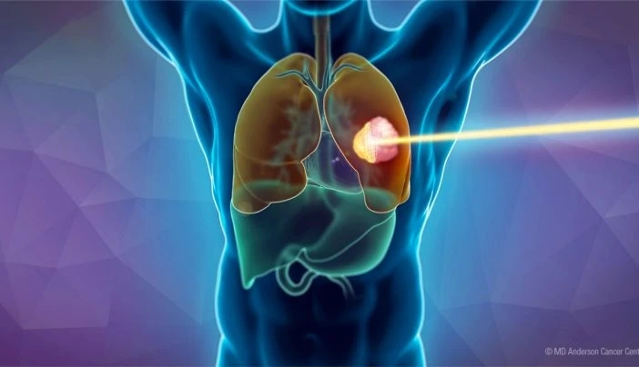 Lung Cancer Therapeutics; Used To Remove Tumors Through Surgery, Chemotherapy, Radiation, And Other Tools