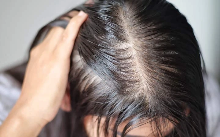 Hair Loss No More: How Professionals Can Assist in Overcoming Hair Loss Issues