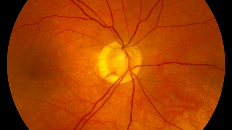 What Do We Know About Stem Cell For Optic Nerve Damage?