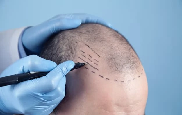 Hair Transplant Turkey for Women: A Life-Changing Solution