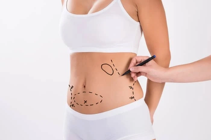 Liposuction Redefined and Perfected
