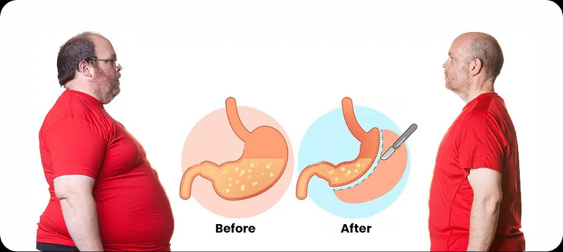 Bariatric Surgery: Types, Benefits, Recovery & Who Really Needs It