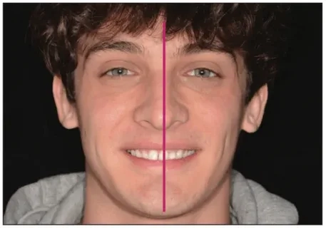 What to Expect During a Smile Enhancement Procedure