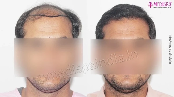 What Are The Parameters For A Good Hair Transplant Candidate?