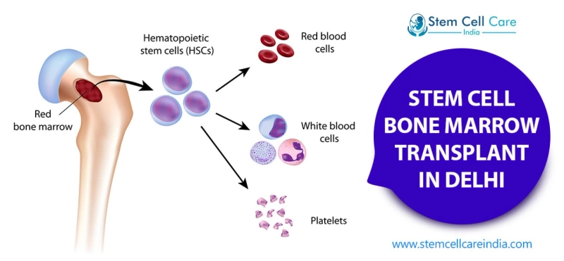 What Do We Know About Stem Cell Therapy For Bone Marrow Transplant