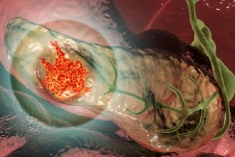 Alfa Cytology Launches Full-Scale Preclinical Services for Pancreatic Cancer Research   