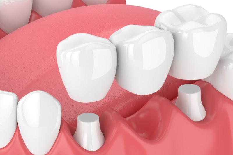 Discover Comprehensive Dental Bridge Services: Enhancing Your Smile
