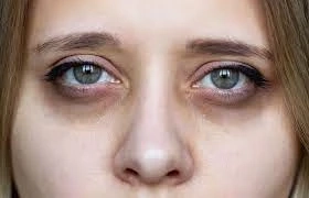 What are Tear Trough Fillers?