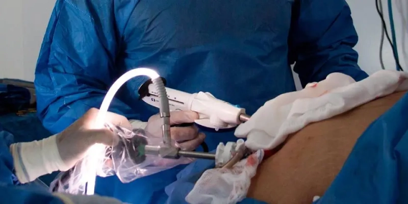 Laparoscopic vs. Open Appendectomy: Which Has Higher Hernia Risk?