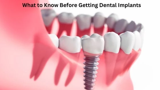 What to Know Before Getting Dental Implants?