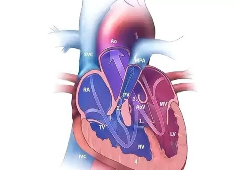 Gently Opening the Door to the Heart: The Evolution of Minimally Invasive Surgery for Congenital Heart Disease