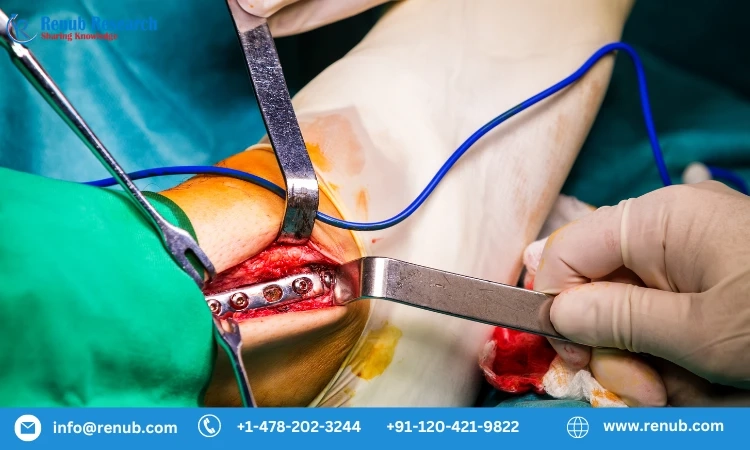 Orthopedic Implants Market is anticipated to reach US$ 68.71 Billion by 2028