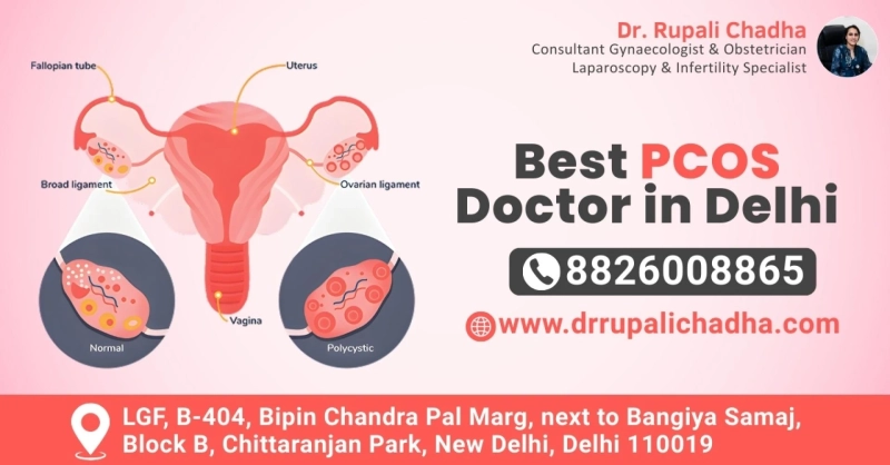 Finding the Best PCOS Doctor in Delhi for Long-Term Women’s Health