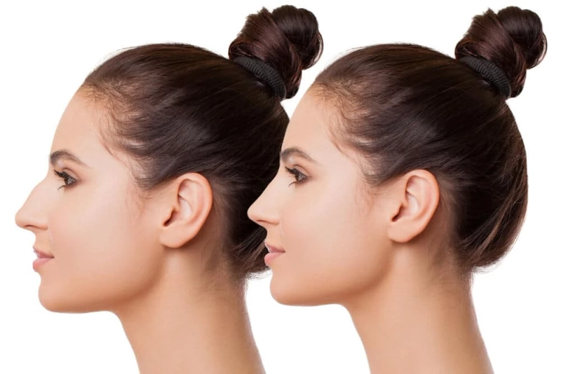 Botox for the nose vs. rhinoplasty - Which is better for me?