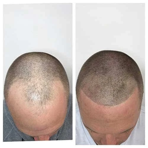 Regain Your Confidence with Scalp Micropigmentation Dubai