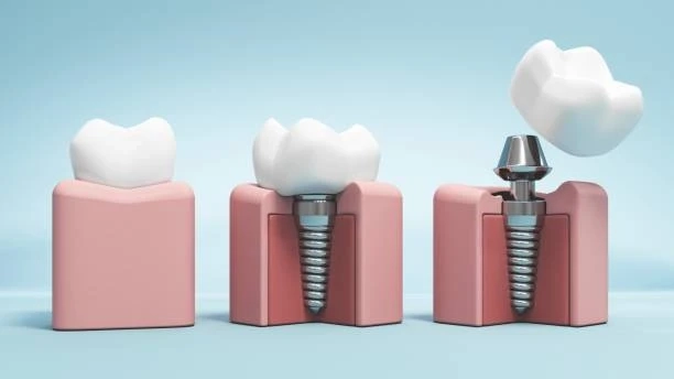 Dental Implants Explained: Cost, Benefits & Recovery Guide
