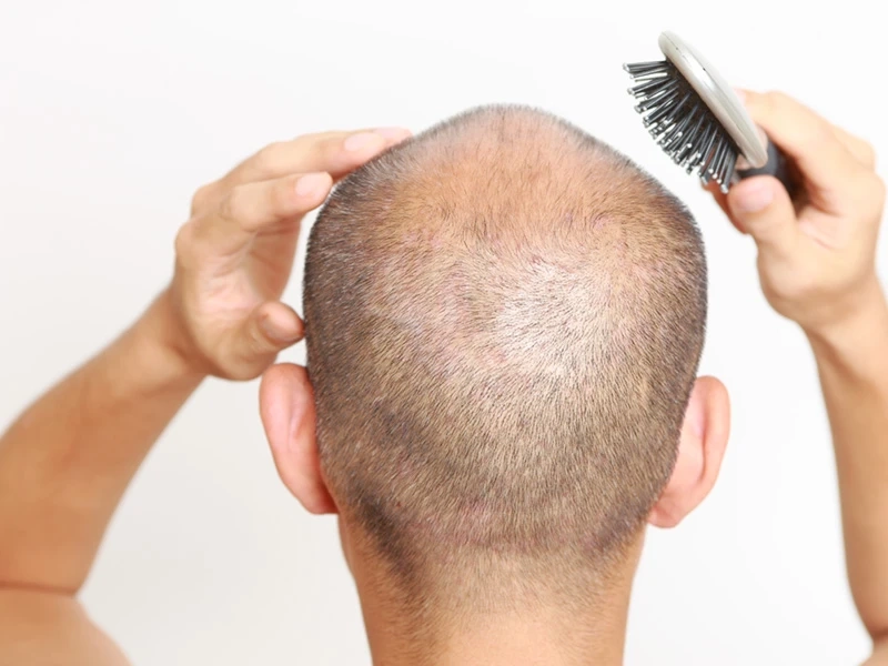 How To Find The Best Hair Transplant Clinic in Mumbai?