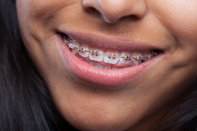 Tooth Coloured Braces: An Ultimate Guide