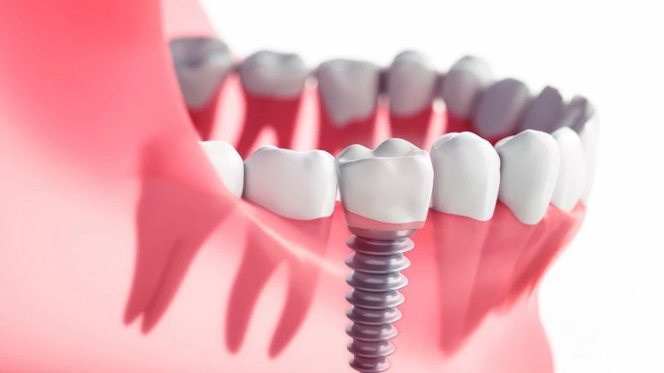 What are the 3 Stages of Dental Implants?