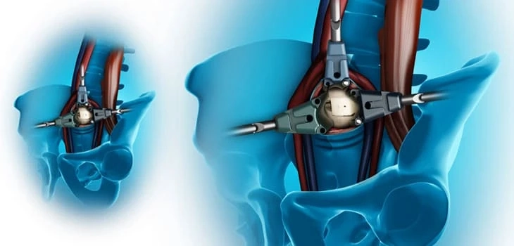 Spinal fusion devices are increasingly popular because they can reduce pain and improve quality of life