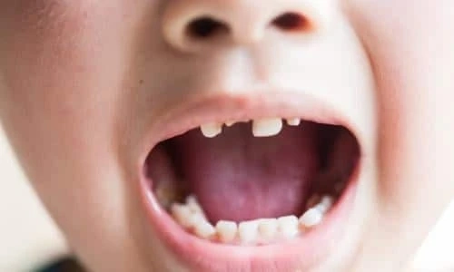Do’s & Don’ts of Tooth Extraction for Kids