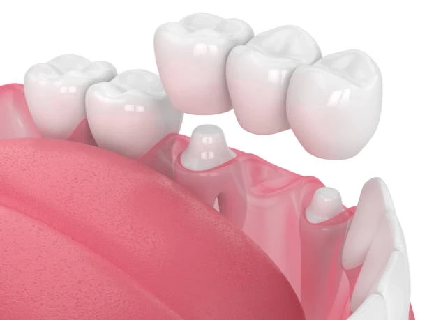 When Do You Need a Dental Crown? Key Signs & Uses
