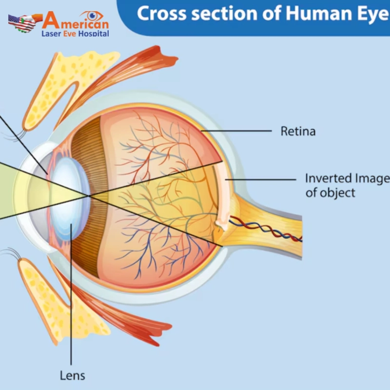 Retina Laser Treatment In Hyderabad |  American Laser Eye Hospitals