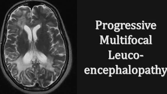 Progressive Multifocal Leukoencephalopathy Treatment Market is anticipated to reach US$ 1,773.97 million by 2033