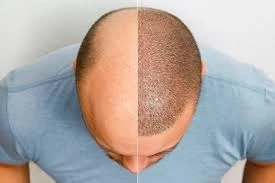 The Truth Behind Beard Transplant Before and After Results