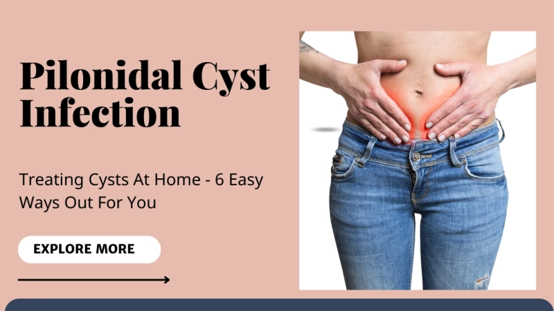 How to deal with a Pilonidal Cyst Infection