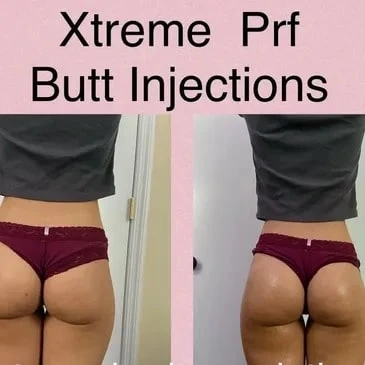 Enhancing Your Curves: A Comprehensive Guide to Breast and Butt Enhancement in Florida