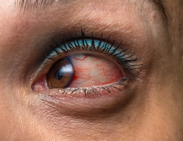 Uveitis Treatment is administered to those going through the condition in all healthcare sectors of