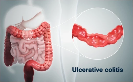 Ulcerative Colitis: Ayurvedic Healing for Pittaja Grahani Roga