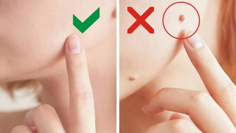 The Ultimate Guide to Freezing off Moles Safely and Effectively