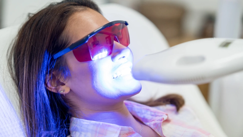 The Science of Teeth Whitening: Professional vs. At-Home Methods