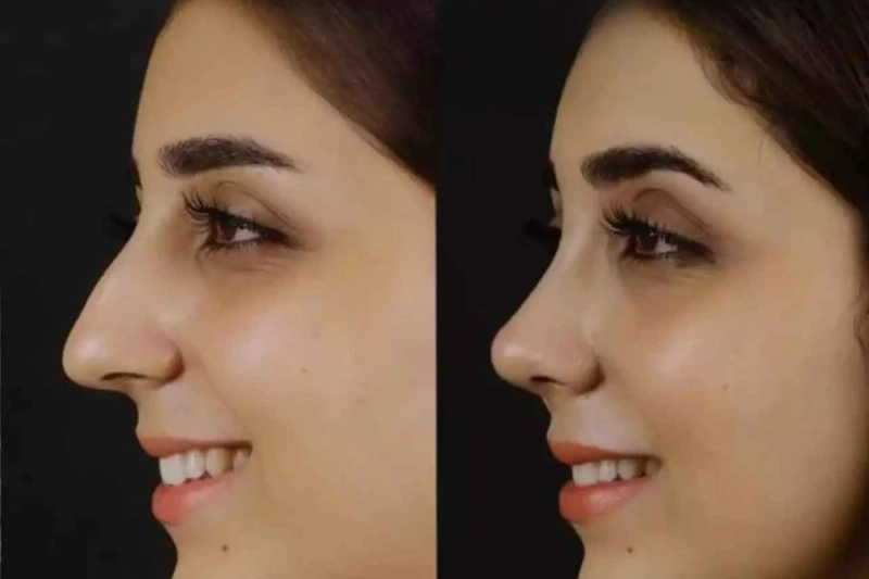Septoplasty in Dubai: A Modern Surgical Approach to Better Breathing