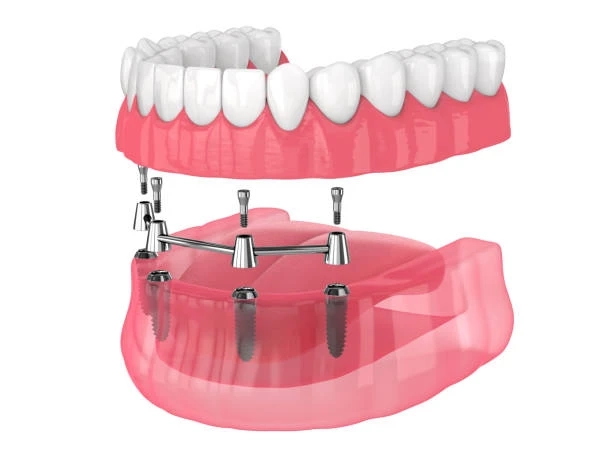 Affordable Denture Options: How to Restore Your Smile on a Budget