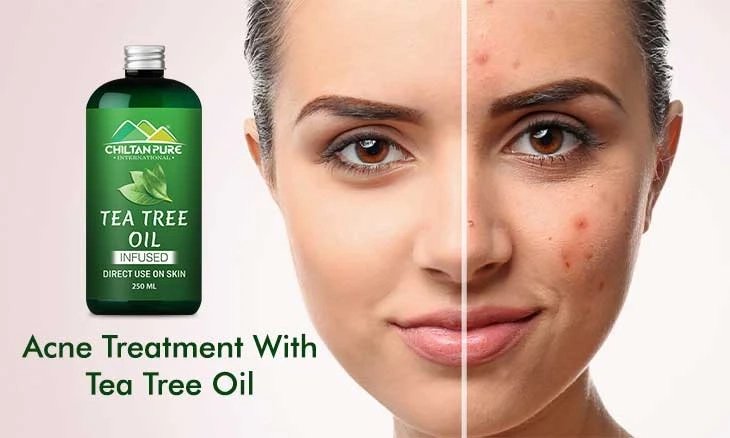 Tea Tree Oil Best For For Acne