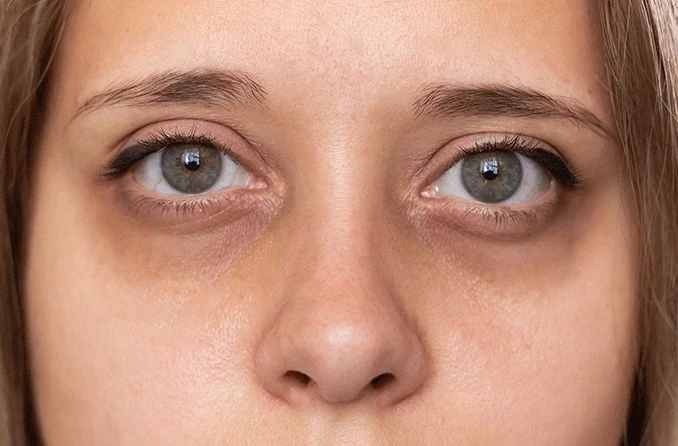 Redefining Beauty Standards: Dark Circles Treatment in Dubai