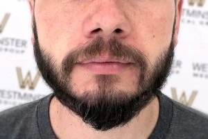 Real Patient Results: Beard Transplant London Before and After