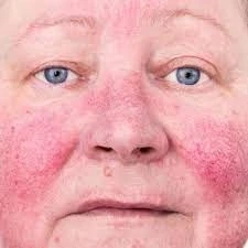 Comprehensive Treatment for Actinic Keratosis in Dubai